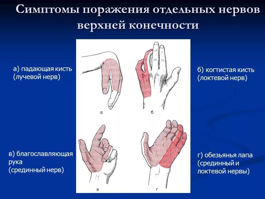 Повреждение локтевого нерва симптомы. Симптомы поражения срединноонерва. Синдром поражения локтевого нерва. Симптомы поражения срединного нерва нерва.