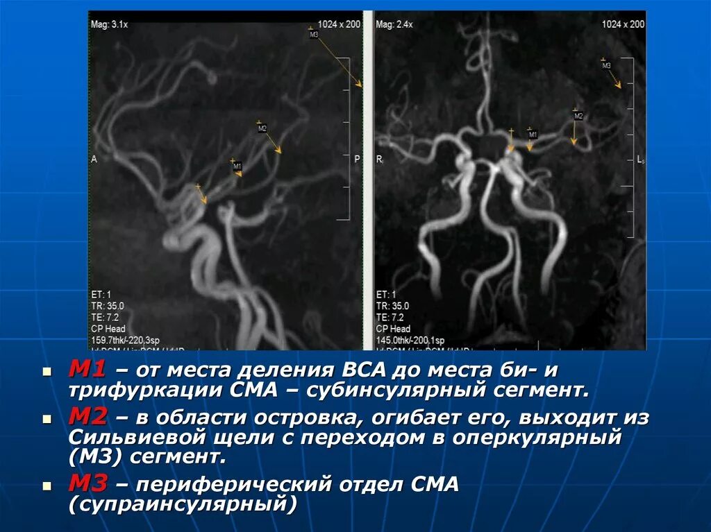 Задняя трифуркация внутренней сонной артерии мрт. Передняя трифуркация левой внутренней артерии. Трифуркация левой внутренней сонной артерии на кт. Трифуркация правой внутренней сонной артерии на кт.