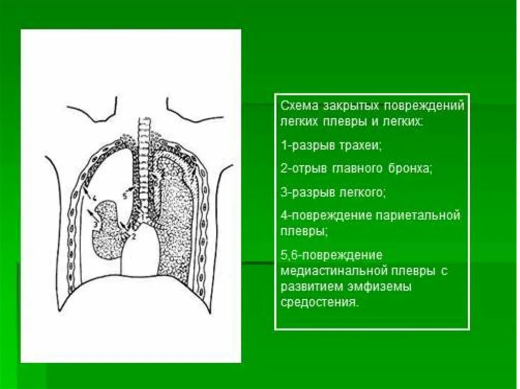 Ушиб легкого на рентгенограмме. Повреждение правого легкого. Повреждение правого легкого. Травмы грудной клетки рентген. Спонтанный пневмоторакс рентген.