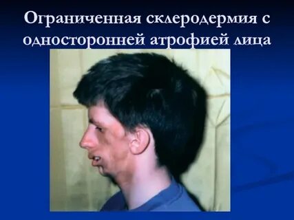 Склероз кожи