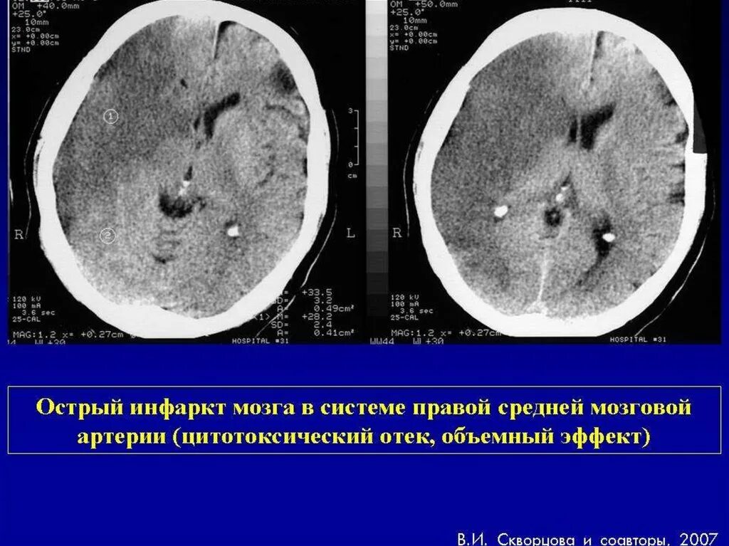 Острый отек мозга. Ишемия ГМ кт. Ишемический инсульт кт. Обширный ишемический инсульт кт. Инсульт ишемия на кт.