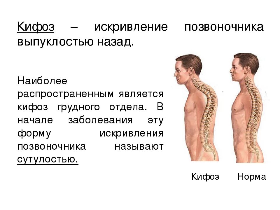 Деформация позвоночника кифоз. Кифоз грудного отдела позвоночника кифоз. Искривление позвоночника лордоз кифоз сколиоз. Сколиоз кифоз грудного отдела.