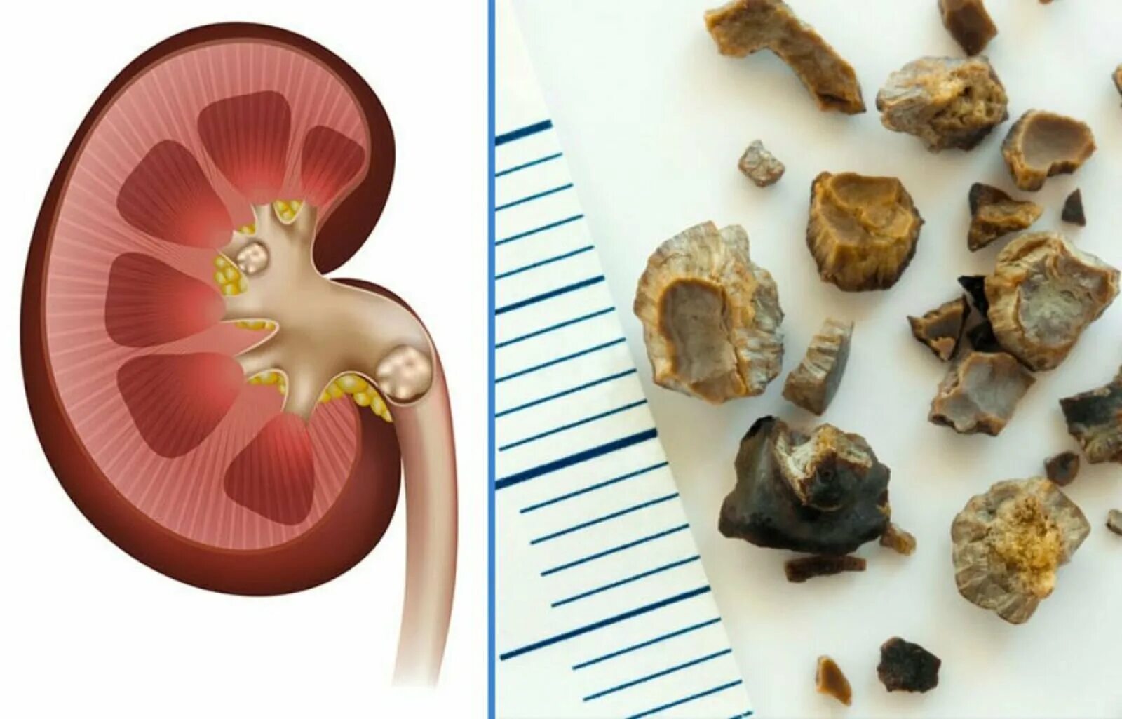 Камни почек куплю. Коралловидный нефролитиаз. Мочекаменная болезнь цистиновые камни.