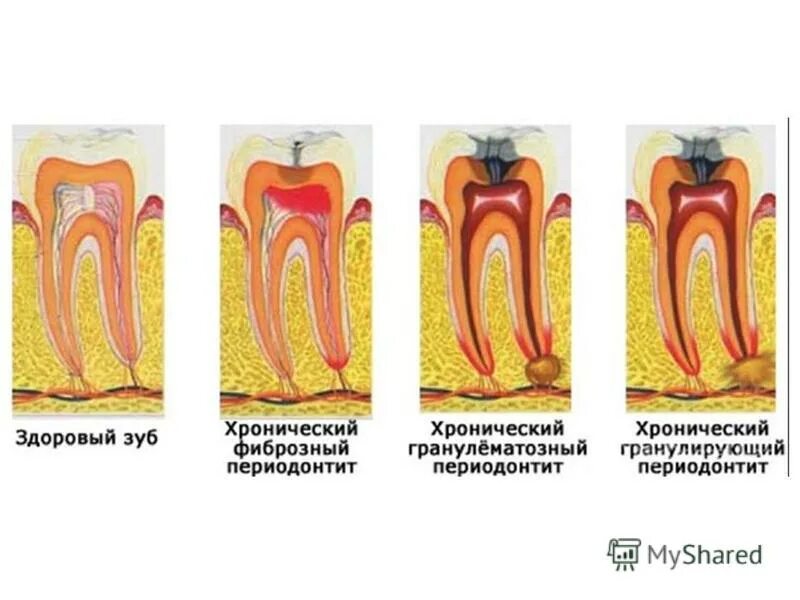 Пульпит сколько дней