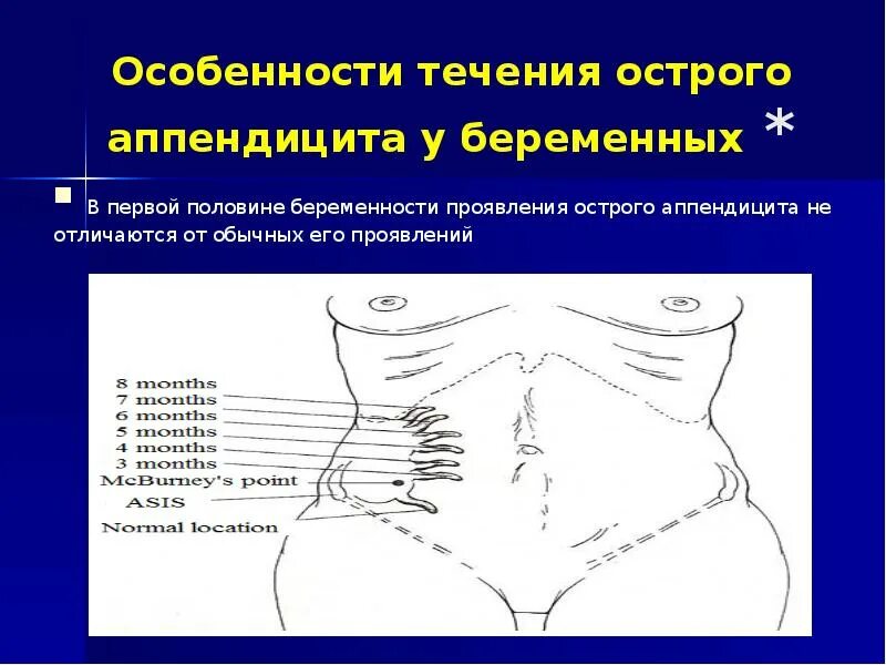 Острый аппендицит начало. Особенности течения аппендицита у беременных. Течение острого аппендицита у беременных. Особенности течения острого аппендицита у беременных. Аппендэктомия у беременных.