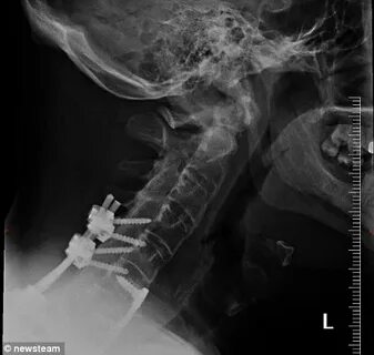 Broken necked