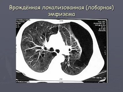 Врожденная долевая эмфизема
