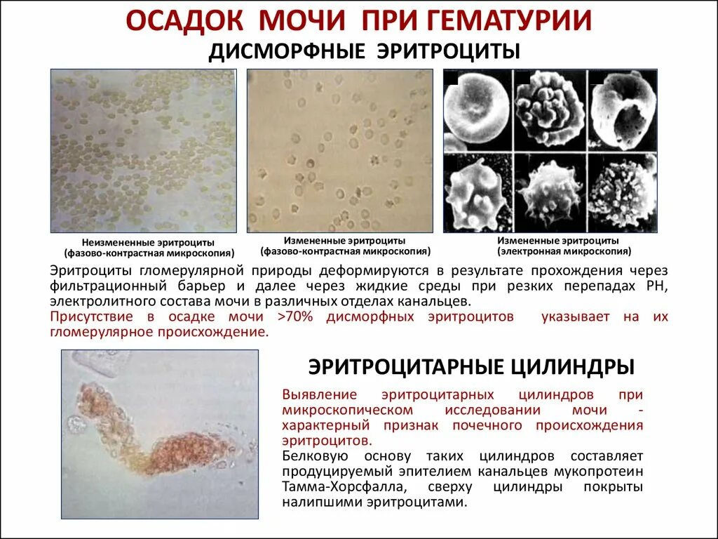 Фазовоконтрастная микроскопия мочевого осадка. Фазово-контрастная микроскопия осадка мочи. Фазово-контрастная микроскопия эритроцитов. Фазово-контрастная микроскопия: дисморфные эритроциты. Появление эритроцитов в моче