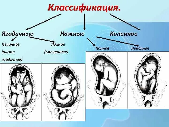 Неполное ягодичное предлежание. Полное ножное ягодичное. Смешанное ягодичное (полное).