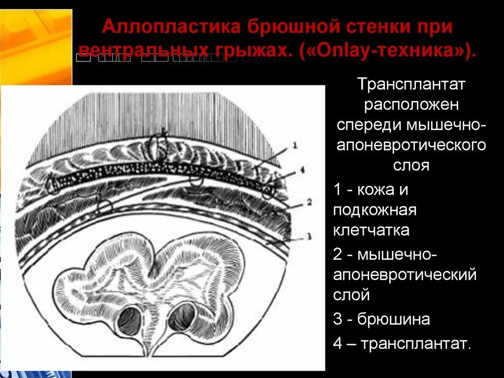 Брюшная стенка после операции. Аллопластика при грыжах. Послеоперационные грыжи аллопластика. Аллопластика при грыжах вентральных грыж.