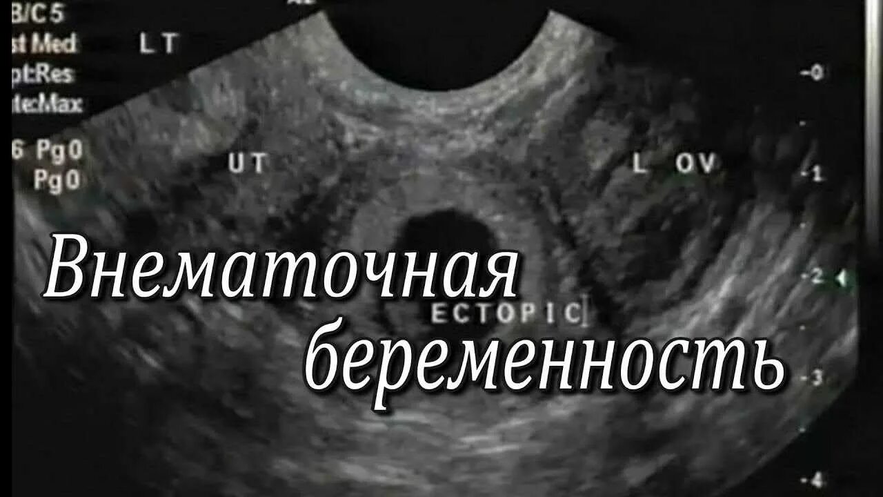 Внематочная беременность на УЗИ. Внематочная беременность на УЗИ на ранних. УЗИ внематочной беременности на раннем сроке. Внематочная беременность по УЗИ.