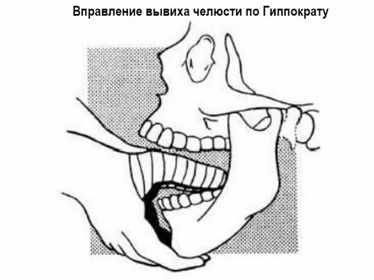 Не может открыть рот челюсть. Методика вправления вывиха нижней челюсти. Вывих нижней челюсти метод Гиппократа. Методы вправления нижней челюсти.
