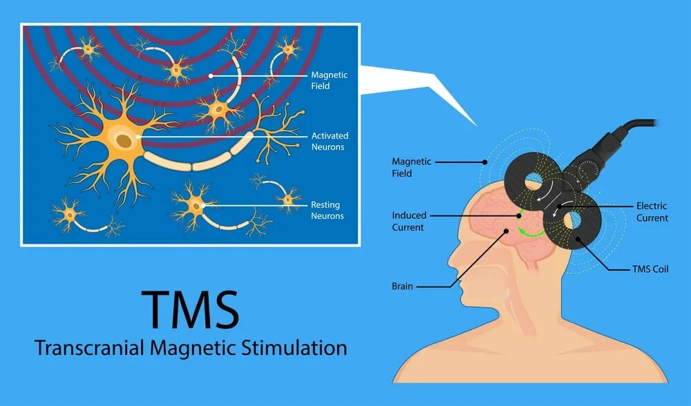 Мозг магнитное поле. Магнитная стимуляция мозга. Транскраниальной магнитной стимуляции. Транскраниальная магнитная стимуляция головного мозга. Магнитная стимуляция ТМС.