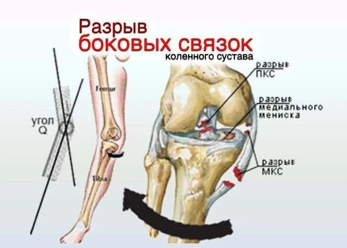 Латеральный разрыв. Повреждение наружной боковой связки левого коленного сустава ?. Разрыв внутренней боковой связки коленного сустава. Повреждение латеральной связки коленного сустава. Разрыв наружной боковой связки коленного сустава.