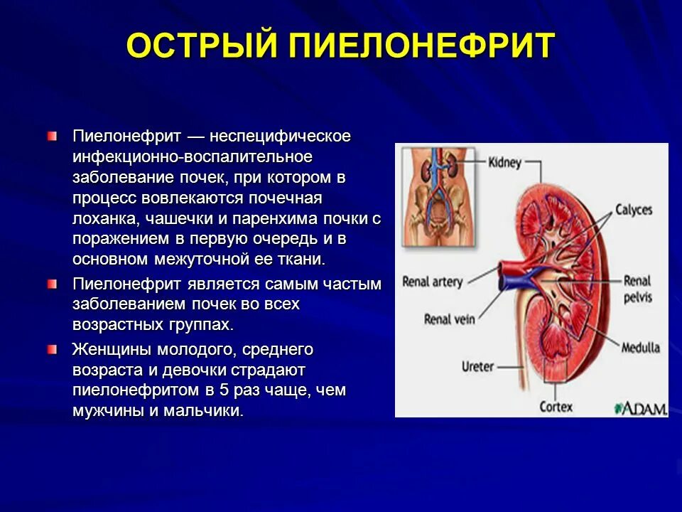 Что может привести к инфекционному заболеванию почек. Острый правосторонний пиелонефрит. Пелонифри. Воспаление почки острый пиелонефрит.