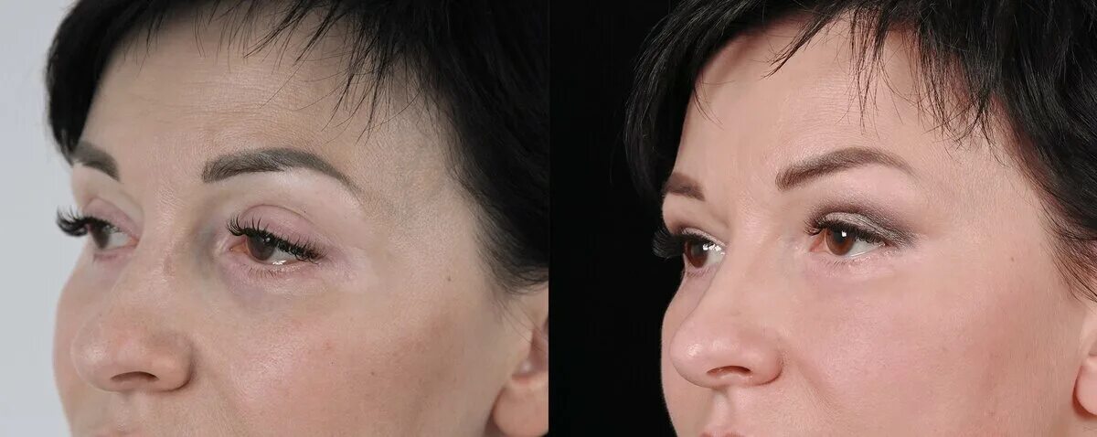 Пластика верхних век с исправлением асимметрии и липофилинг нижних век - Cosmeti