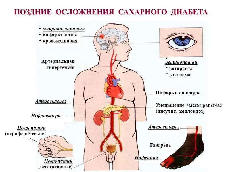 Заболевания сопутствующие диабету. Осложнения сахарного диабета 2 типа. Осложнения при сахарном диабете 1 типа. Осложнения СД 1 типа и 2 типа. Осложнения от сахарного диабета 1 типа.