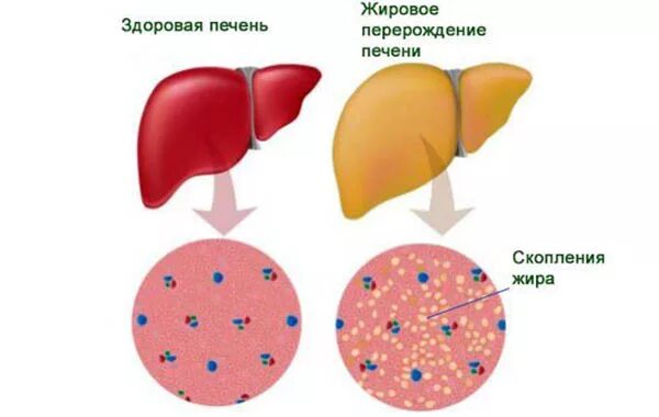 Дистрофия печени причины. Жировая инфильтрация печени. Жировой гепатоз печени острый. Острый жировой гепатоз беременных. Жировая инфильтрация печени стеатоз.