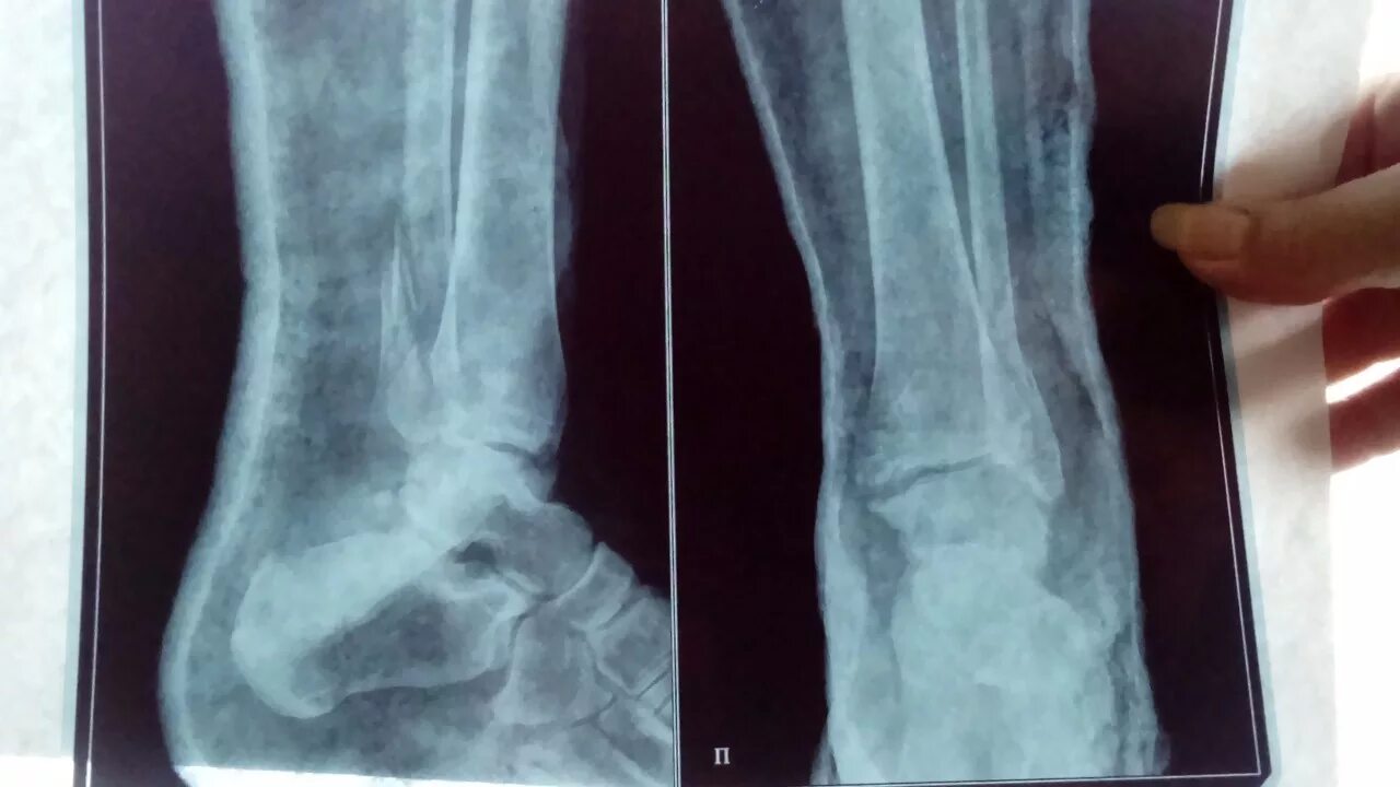 Рентген руки перелом со смещением. Гипс при переломе лодыжки. Косой перелом малоберцовой кости. Лангетка для перелома лучевой кости. Перелом метаэпифиза лучевой кости.