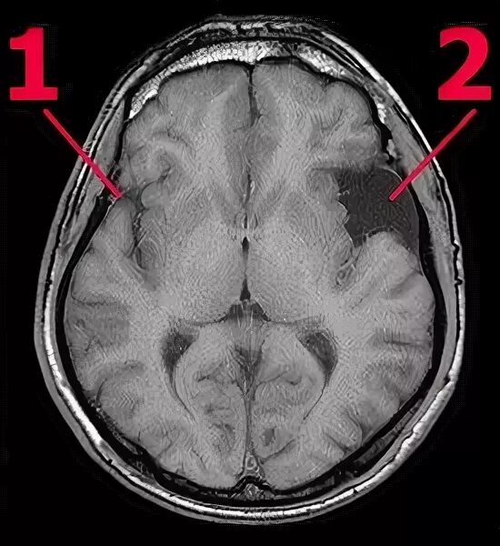 Височная киста головного мозга. Арахноидальная киста височной доли кт. Мрт головного мозга арахноидальная киста левой височной доли. Арахноидальная киста затылочной области кт. Арахноидальная киста левой височной доли кт.