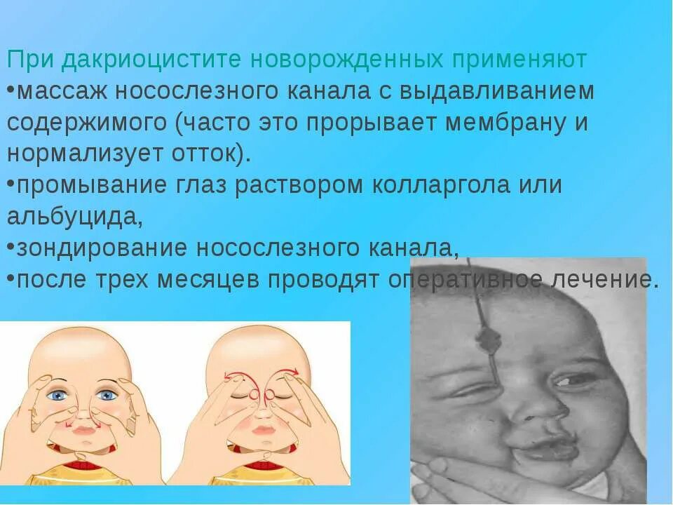 Дакриоцистит новорожденных Офтальма. Массаж при дакриоцистите новорождённых. Массаж слезного канала у новорожденного.