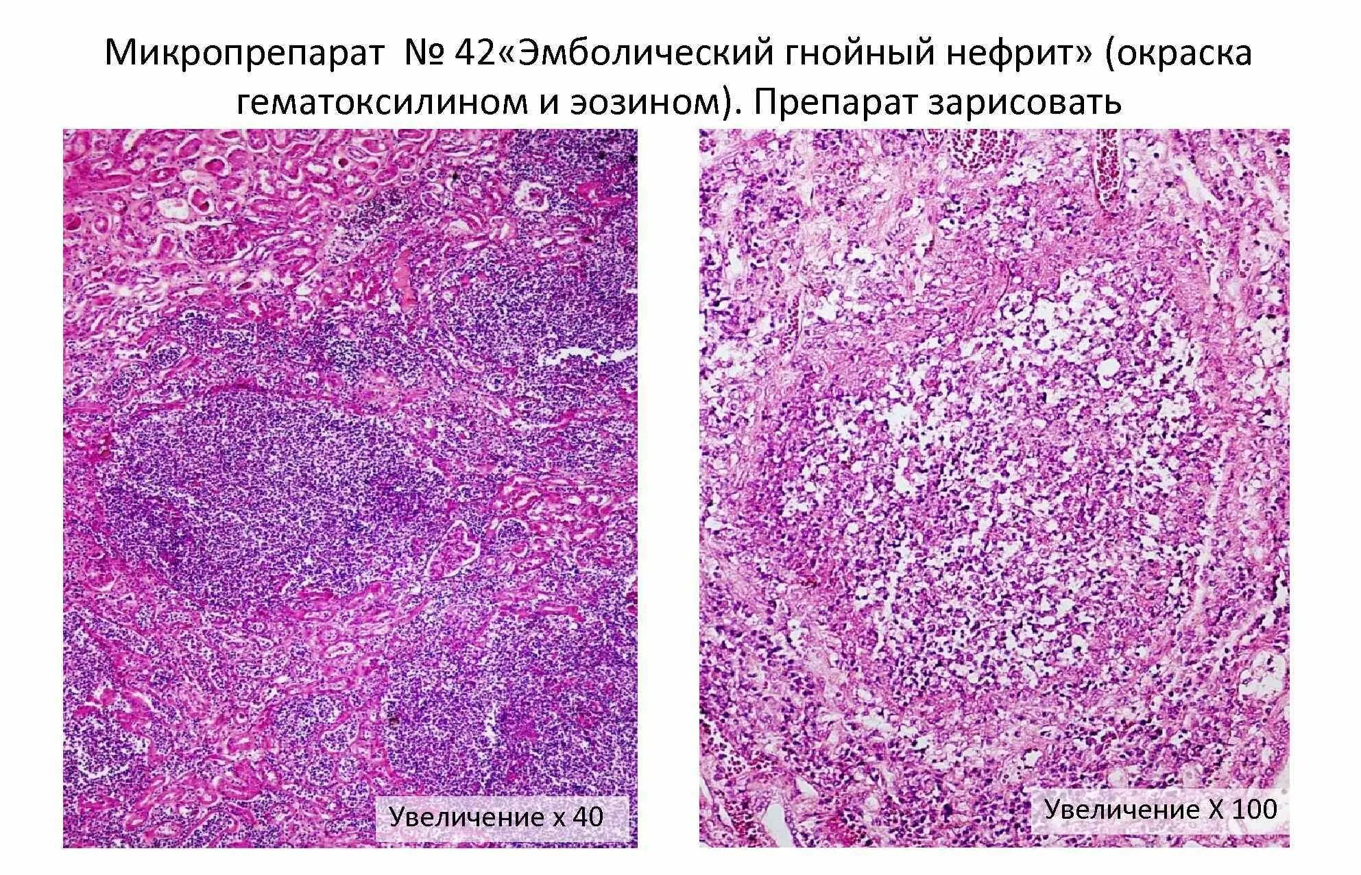 Острый гнойный пиелонефрит. Острый Гнойный нефрит микропрепарат. Межуточный нефрит патанатомия. Хронический пиелонефрит патанатомия микропрепарат. Эмболический Гнойный нефрит патанатомия макропрепарат.