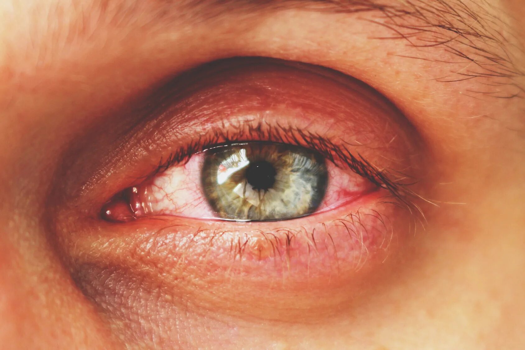 Хронические заболевания зрения. Хламидийный конъюнктивит-кератит.