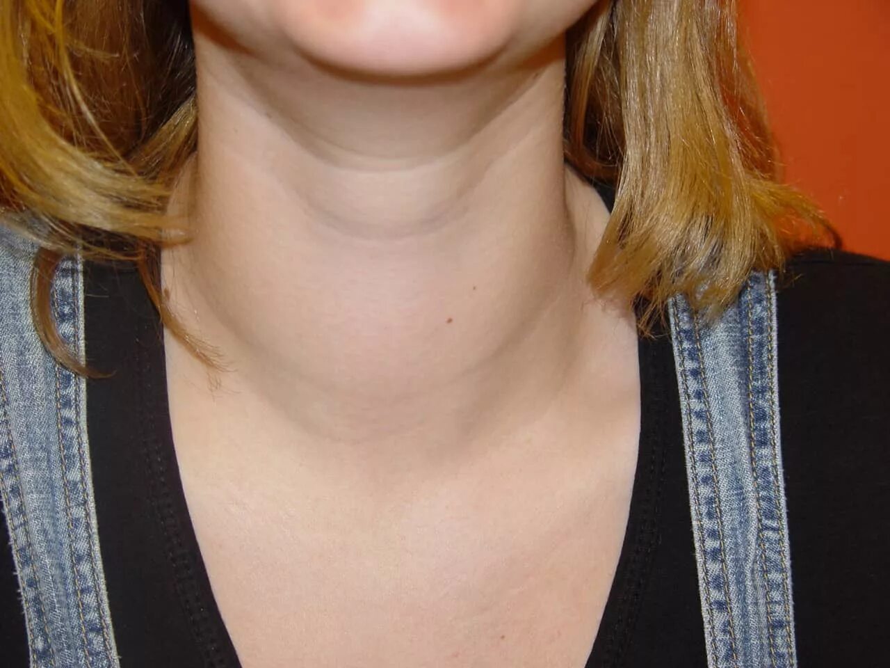 Увеличенная щитовидная железа. Толстая шея признак
