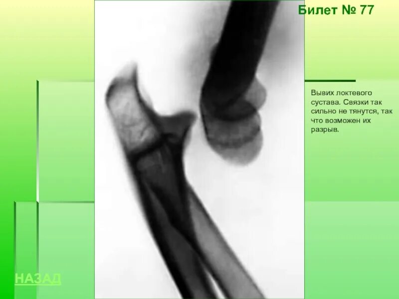 Разрыв назад. Полный вывих локтевого сустава. Передний вывих локтевого сустава.