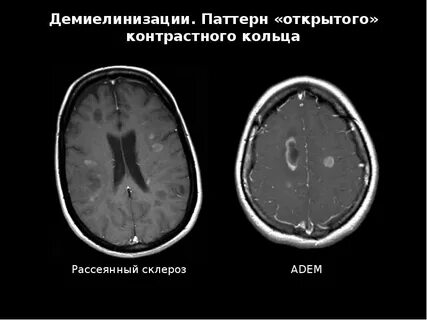 Демиелинизация