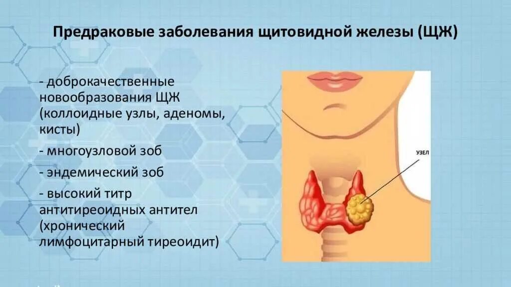 Почему образуются узлы. Узлы в щитовидной железе. Новообразование щитовидной железы. Узловые образования щитовидной железы.