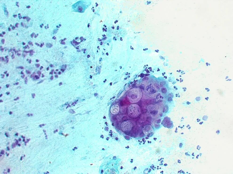 Chlamydia trachomatis. Возбудитель хламидии трахоматис. Микроскопия хламидиоза. Chlamydia trachomatis микроскопия.