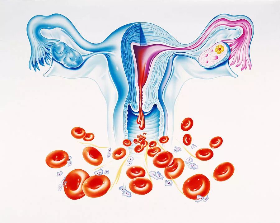Климакс у женщин выделения кровяные. Обильное маточное кровотечение. Аномально маточные кровотечения. Патологические маточные кровотечения.