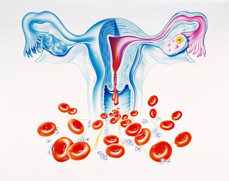 Маточное кровотечение при месячных. Обильное маточное кровотечение. Патологические маточные кровотечения. Межменструальные маточные кровотечения.