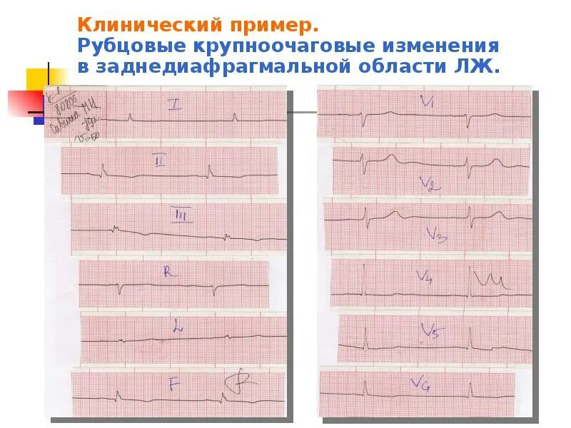 Болезни на экг. Крупноочаговые рубцовые изменения на ЭКГ. Ишемия на ЭКГ. ЭКГ клинический диагноз. Рубцовые изменения на ЭКГ заключения.