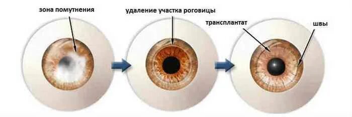 Донор зрение. Сквозная кератопластика ход операции. Кератопластика роговицы глаза. Кератоконус имплантация роговицы. Сквозная пересадка роговицы.