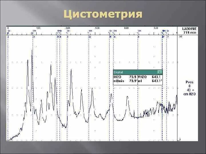 Цистометрия мочевого. Цистометрия опорожнения. Цистометрия мочевого. Куди обследование мочевого. Цистометрия как проводится.