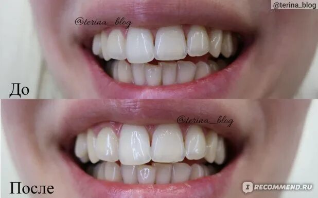 Чистка зубов до и после фото Bleaching Teeth Изображения: просматривайте стоковые фотографии, векторные изобр