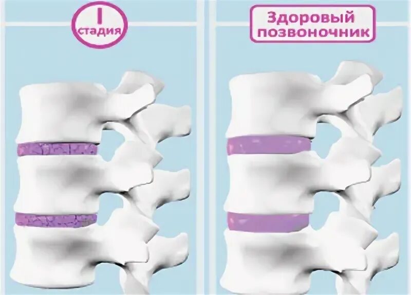 Стадии остеохондроза позвоночника на кт. Остеохондроз 1-2 степени поясничного отдела. Остеохондроз поясничного отдела 2-3 стадии. Периоды развития остеохондроза. Остеохондроз поясничного отдела 1 стадии.