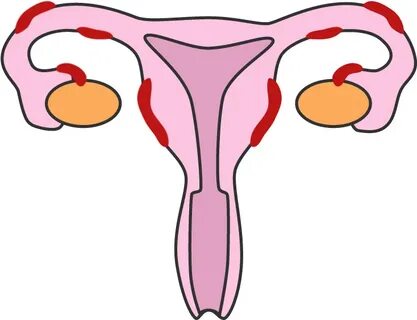 Endometriosis