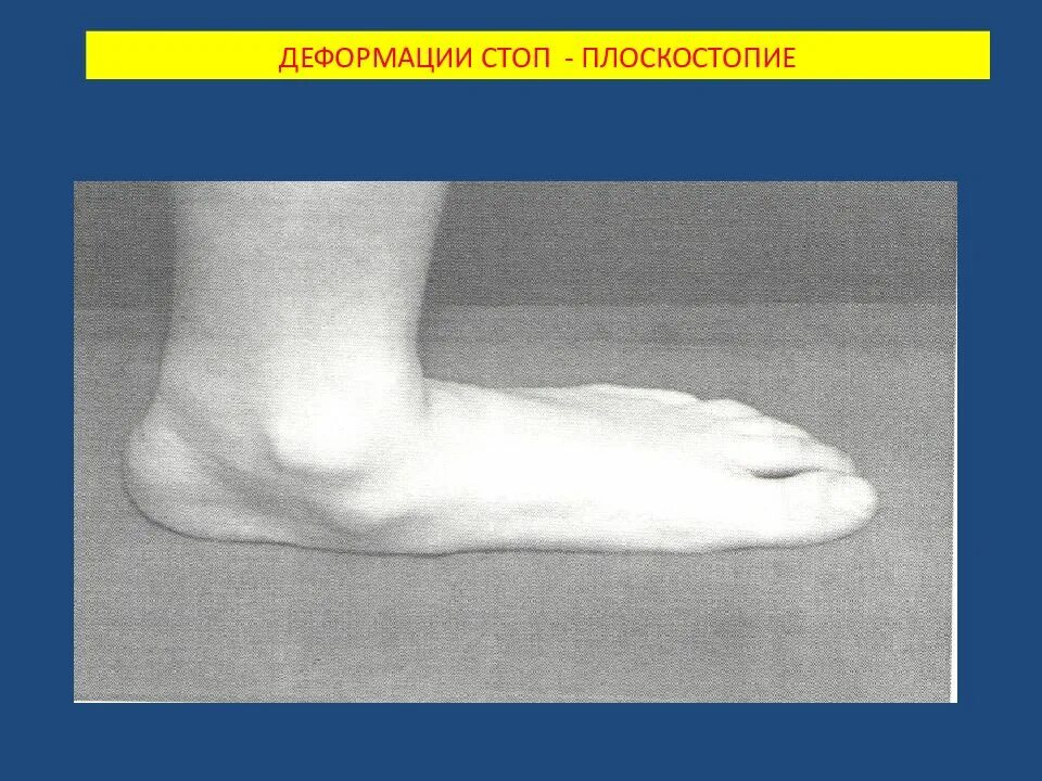 Увеличенная деформация. Плоскостопие деформация стопы. фиксированные деформации переднего отдела стопы. клиновидная деформация стоп. фиксированная деформация стопы что это.
