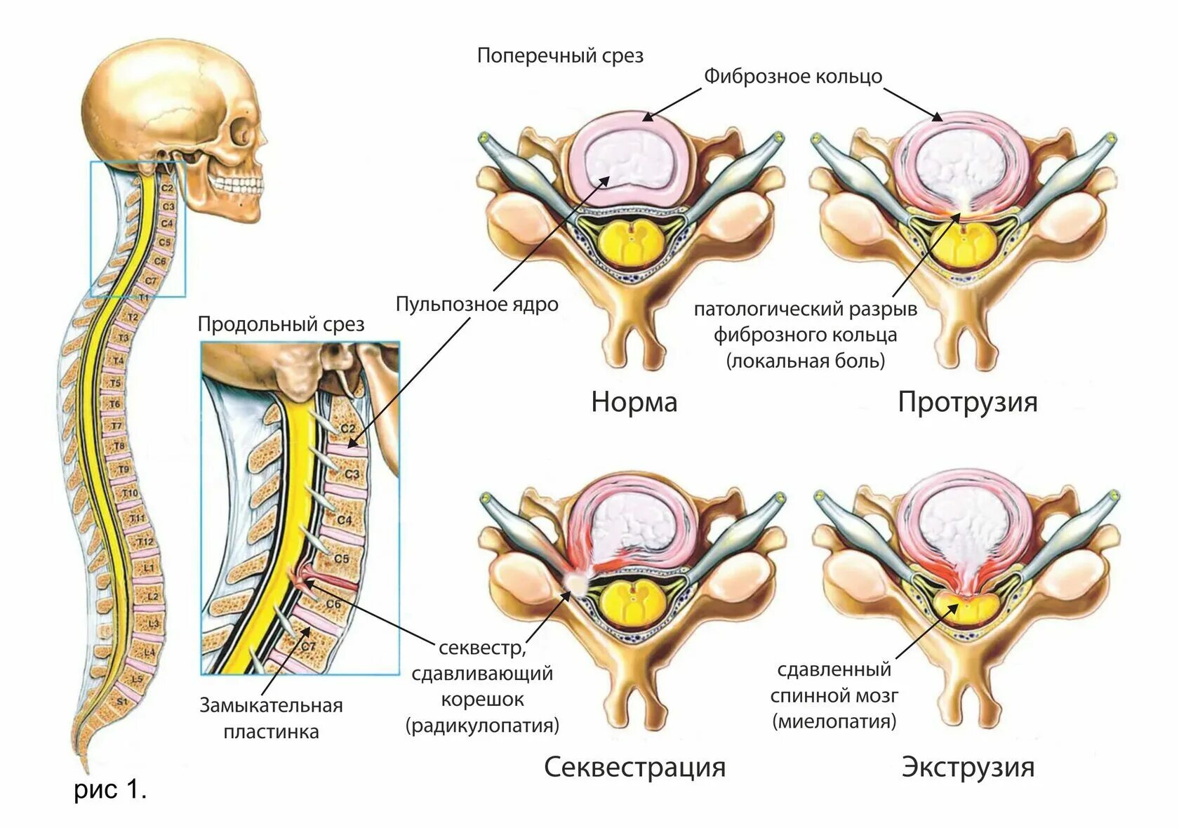 Грыжи дисков. Грыжа диска. Медиолатеральная грыжа диска.