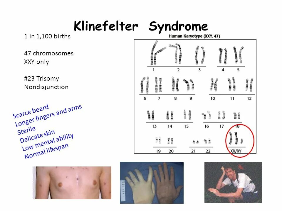 Синдром Клайнфельтера 47 xxy. Синдром Клайнфельтера кариограмма. Xxy синдром Клайнфельтера. Болезнь Клайнфельтера кариотип. Синдром клайнфельтера наследственное