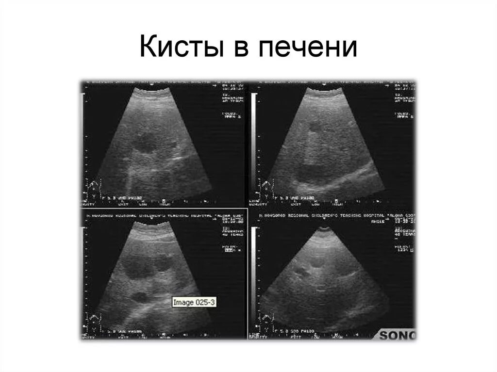 Киста на печени можно. Кисты печени на УЗИ классификация. Многокамерная киста печени УЗИ. УЗИ заключение кисты левой доли печени. Кисты печени печени на УЗИ.