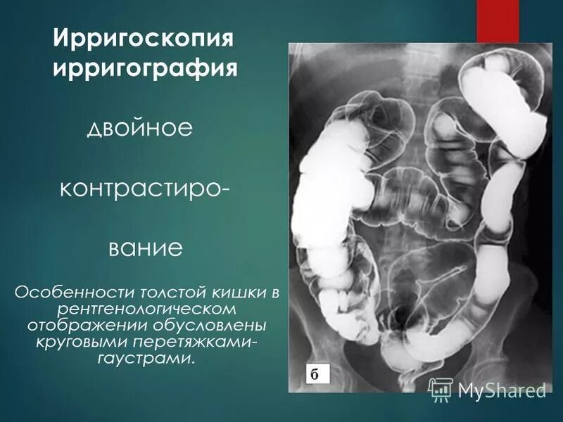 Ирригоскопия с контрастированием. Ирригоскопия методика. Рентгенологическое исследование кишечника ирригоскопия. Ирригоскопия толстой кишки. Метод рентгенологического исследования толстой кишки.
