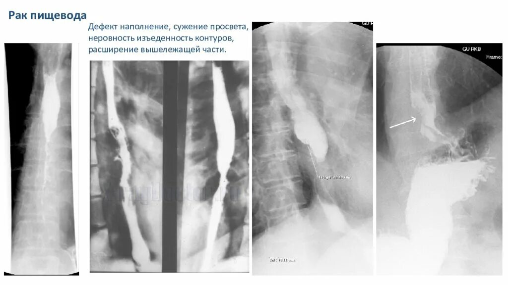 Скопия пищевода. Дефект наполнения пищевода рентген. Лейомиома пищевода рентген. Краевой дефект наполнения пищевода. Аденокарцинома пищевода рентген.