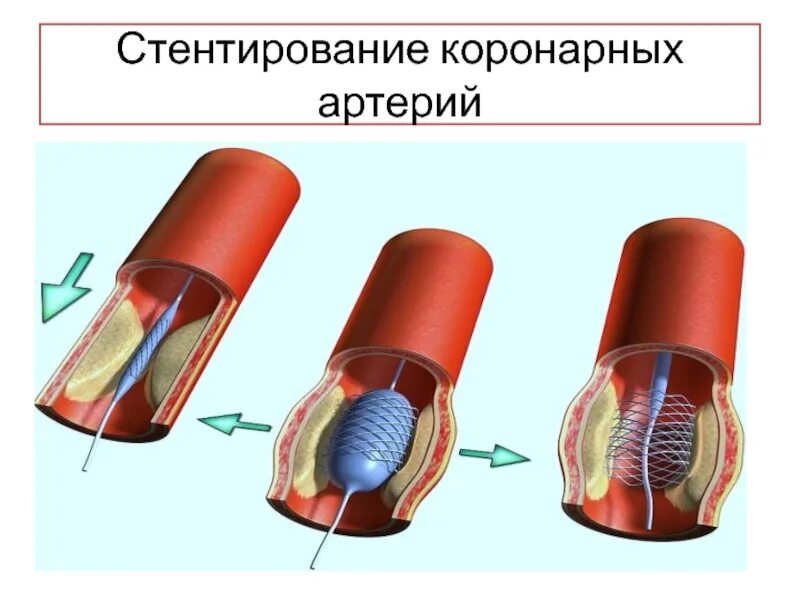 Стентирование код