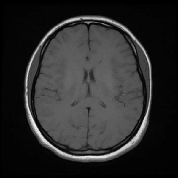 Патологии на мрт. Аксиальная плоскость кт головного мозга. Мрт снимки мозга норма. Кт томограмма головного мозга. Снимок мрт головного мозга в норме.