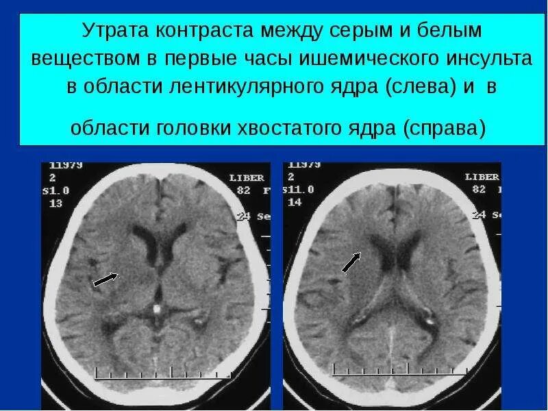 Усиленный в базальных отделах. Ишемический инсульт базальных ядер. Инсульт в базальных ядрах. Ишемический инсульт кт. Ишемический инсульт в базальных ядрах кт.