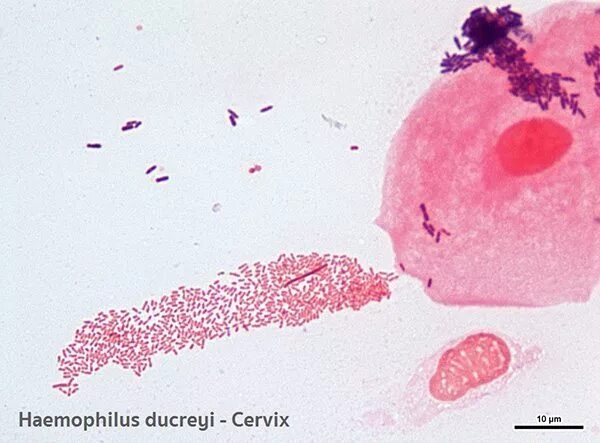 Haemophilus в мазке у мужчин. Гемофильная палочка ducreyi. Haemophilus influenzae морфология.